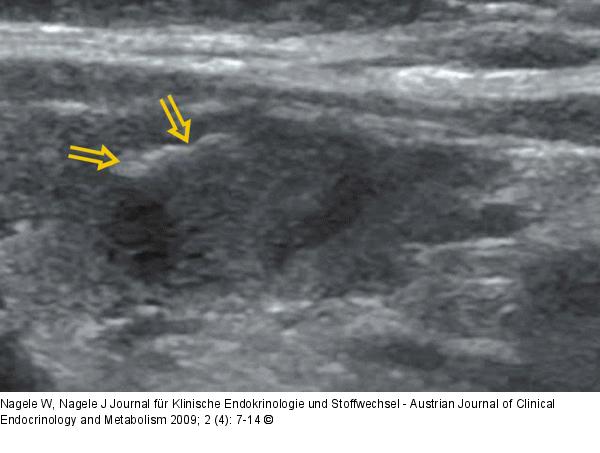 Schilddrüsensonographie