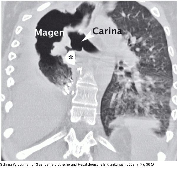 Gastro-bronchiale Fistel
