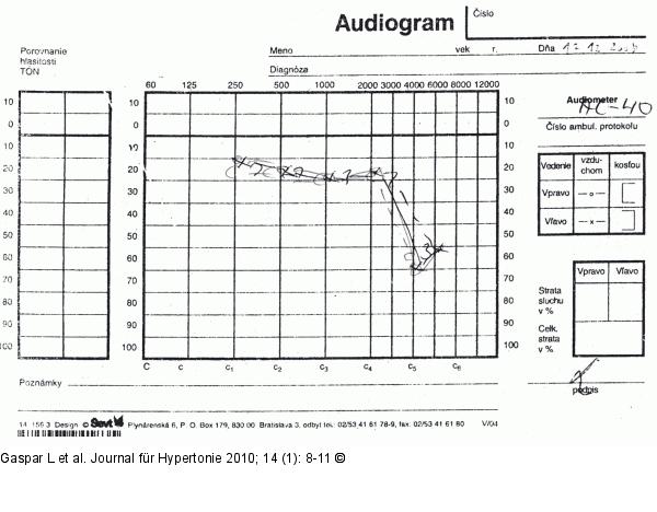 Pathologisches Audiogramm