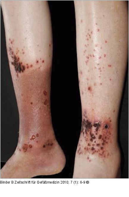 Nekrotisierende Vaskulitis