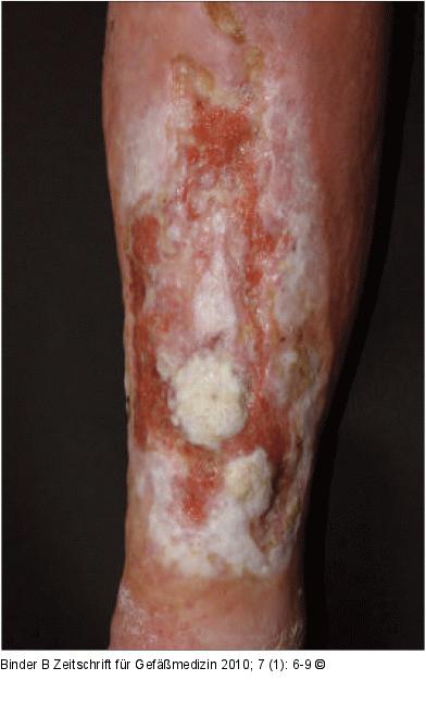 Plattenepithelkarzinom