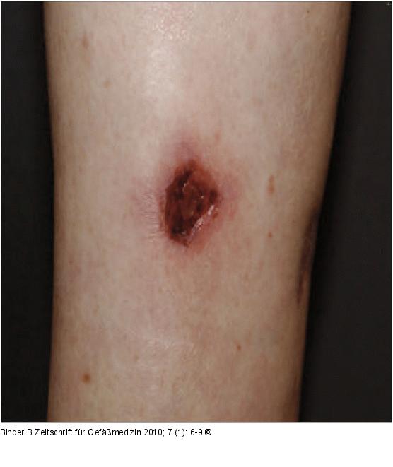 Pyoderma gangraenosum