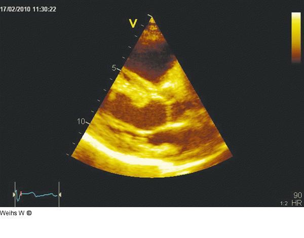 Transthorakale Echokardiographie