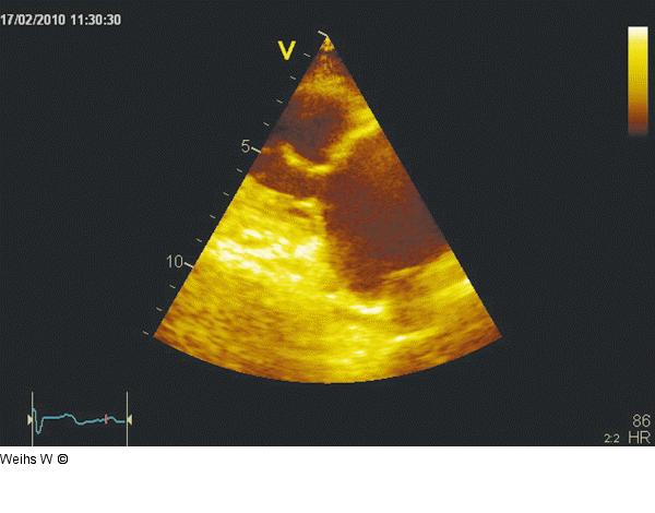 Parasternaler Längsschnitt