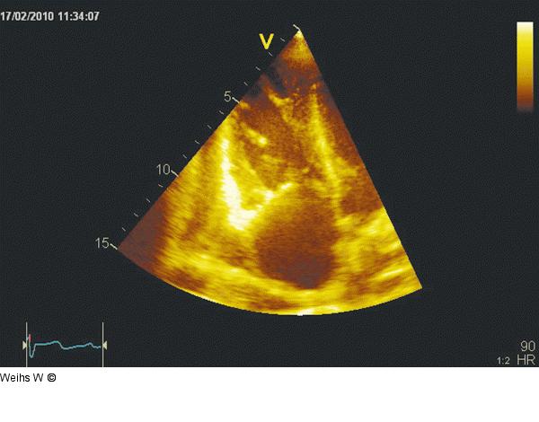 Apikaler 4-Kammerblick