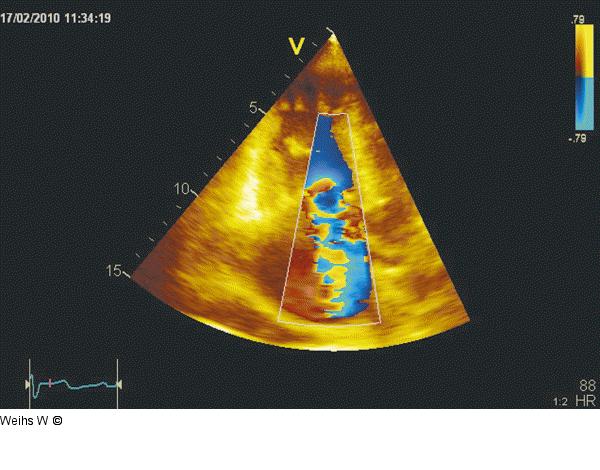 Trikuspidalinsuffizienz