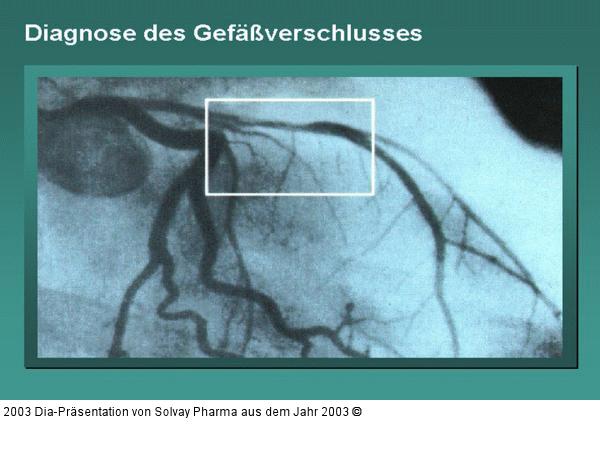 Diagnose des Gefäßverschlusses