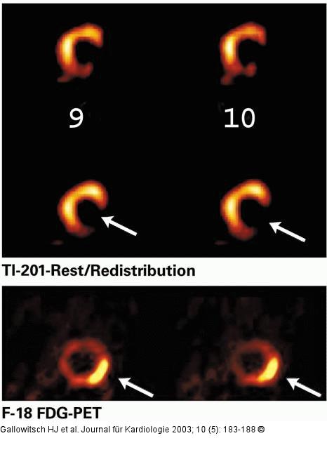 PET - Glukosemetabolismus