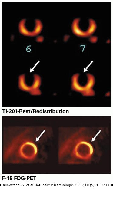 PET - Glukosemetabolismus