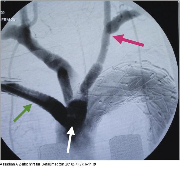 Abschlussangiographie