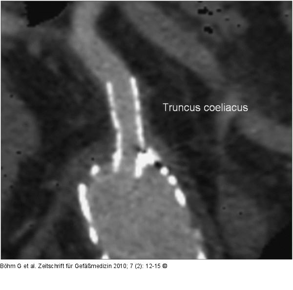 CT - MIP-Rekonstruktion