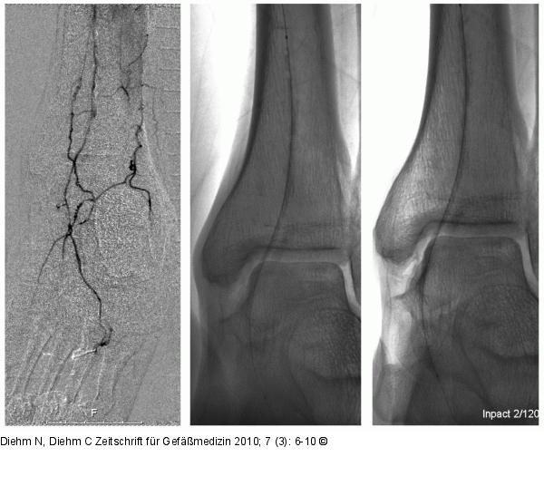 A. dorsalis pedis - A. plantaris pedis