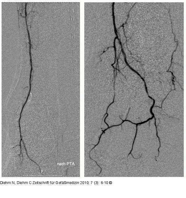 Distaler Unterschenkel