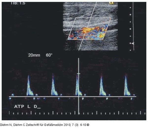 A. tibialis posterior