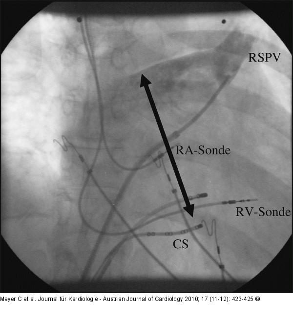 Pulmonalvenenangiographie