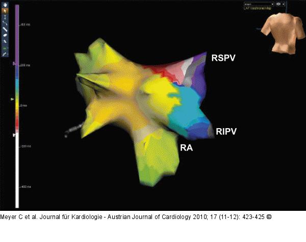 Referenzelektrogramm