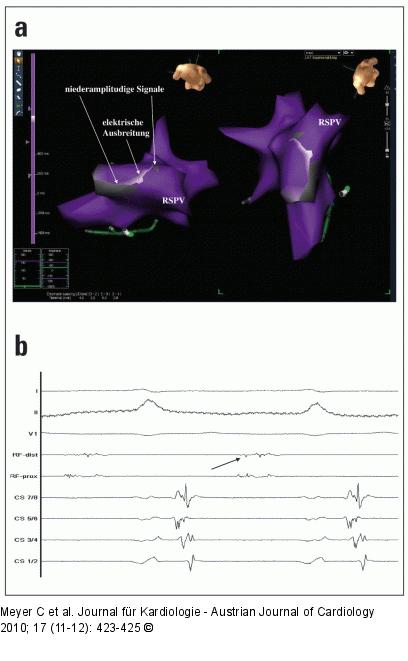 Elektrische Erregungsausbreitung - Endokardiales Elektrogramm