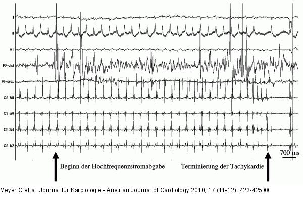 Arrhythmie