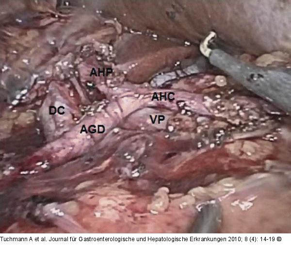 Lymphknotendissektion