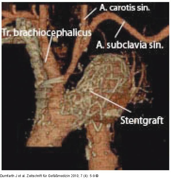 Stentgraft