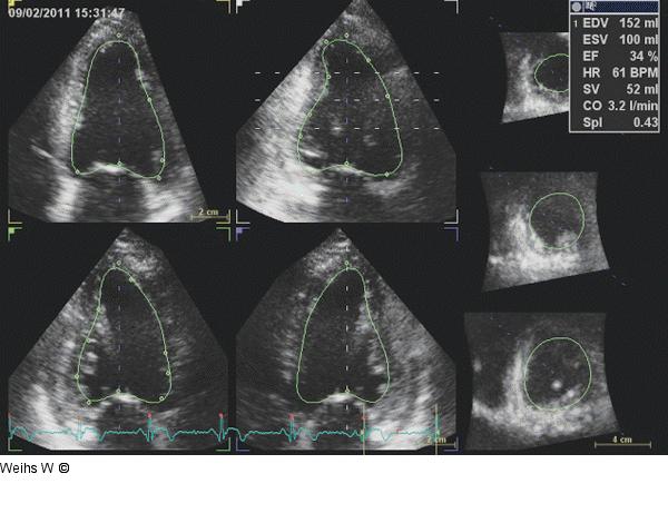 Linksventrikuläre Volumina -  EF