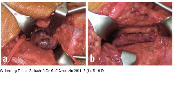 Intraoperativer Befund