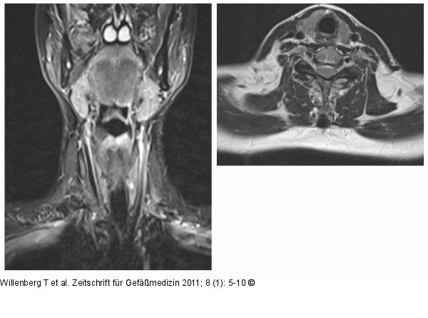 Kontrolle 3 Monate nach Sklerosierung