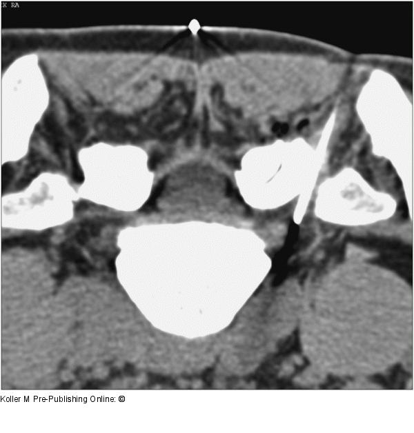 Nervenwurzelinfiltration