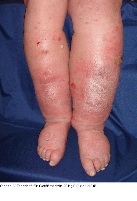 Stauungsdermatitis