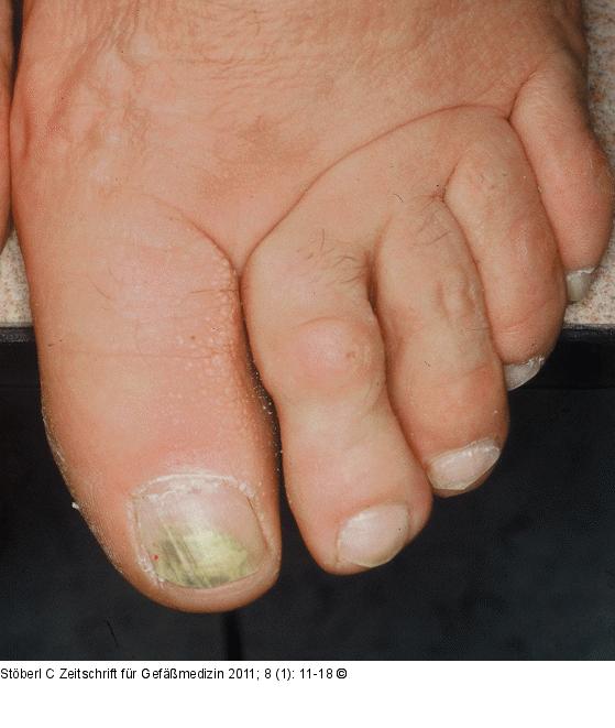 Aszendierendes Lymphödem