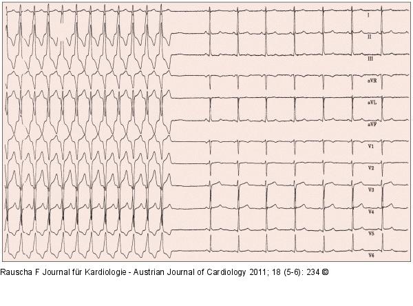 Breitkomplextachykardie