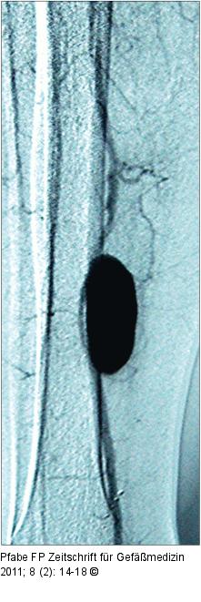 Insuffizienz der distalen Bypassanastomose