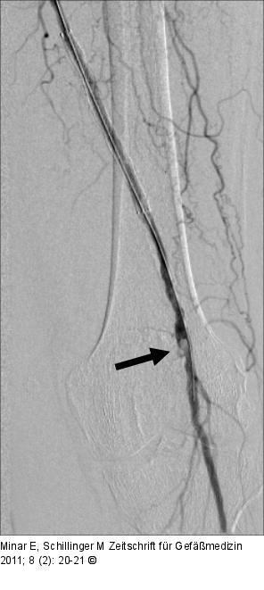 Ballonangioplastie