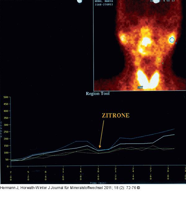 pathologische Speicheldrüsenfunktion
