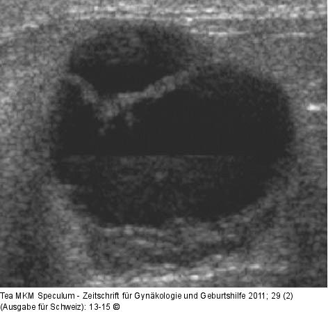 Komplizierte Mammazyste