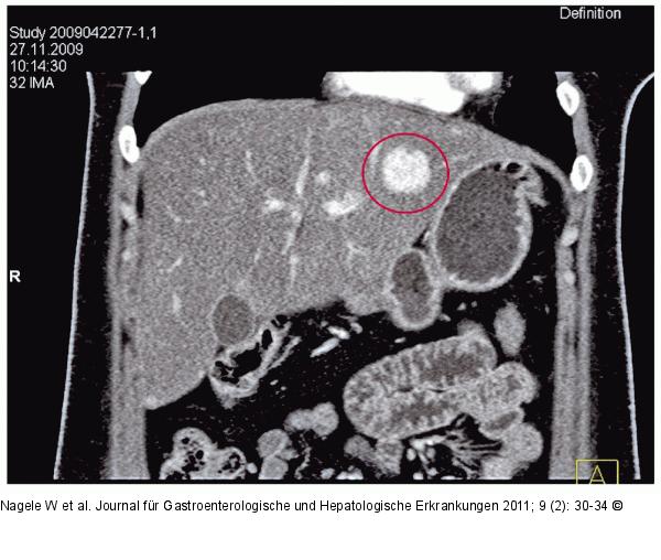 CT des Oberbauchs mit Kontrastmittel