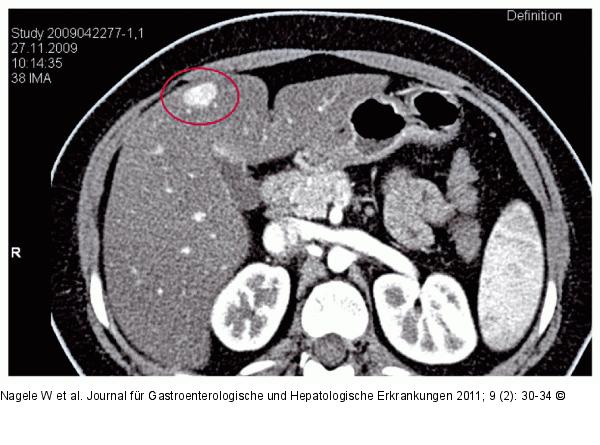 CT des Oberbauchs mit Kontrastmittel