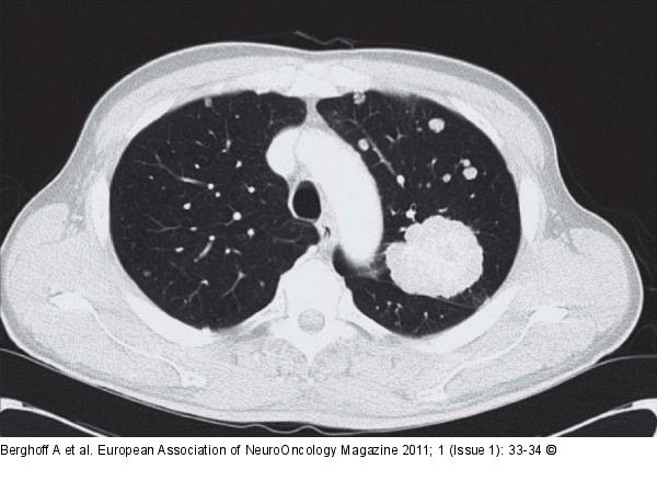 Thoracic CT
