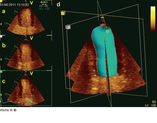Apikale Schnitte - Vierkammerblick
