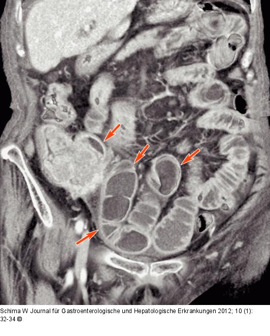 Dilatation - Dünndarmschlingen