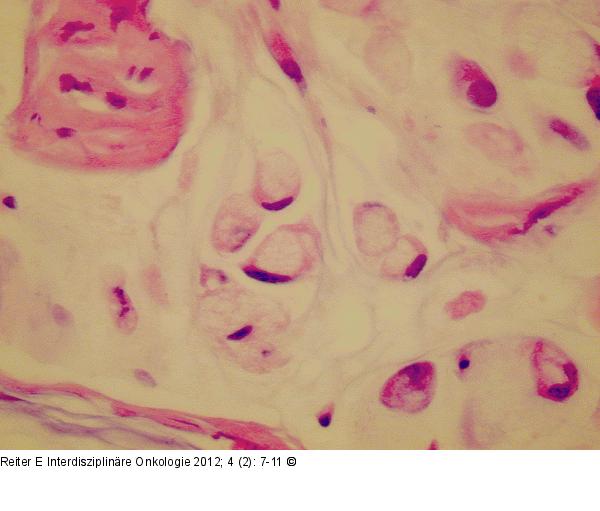 Pseudomyxoma peritonei