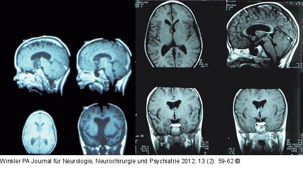 Gelastische Epilepsie