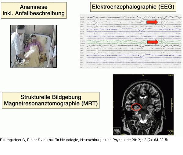 Epilepsie - Diagnostik