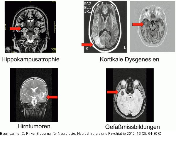 Befundung - Epilepsie