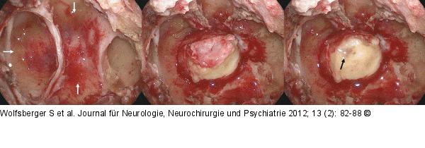 Hypophysenadenom-Apoplexie