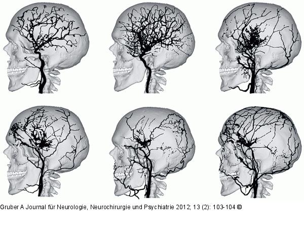 Moya-Moya-Erkrankung