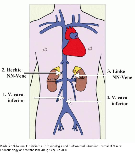 Blutabnahme - Nebennierenvenenkatheter