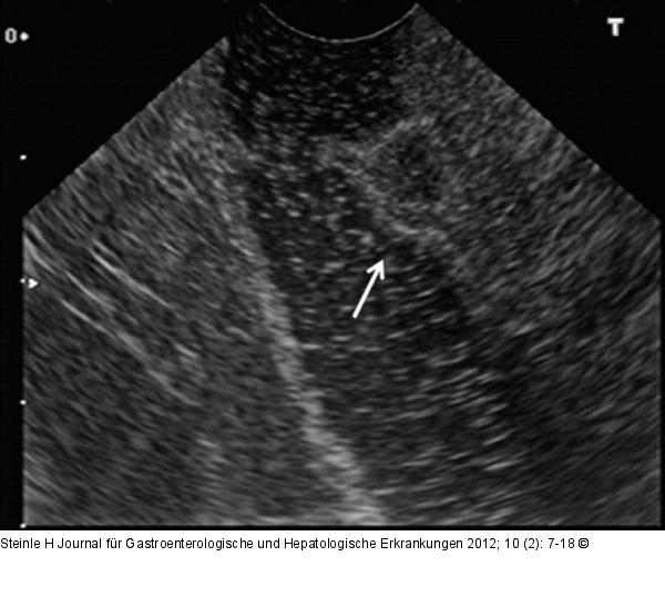 Gastrinom - Duodenum