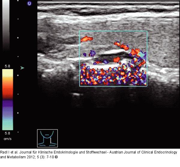 Nebenschilddrüsenadenom