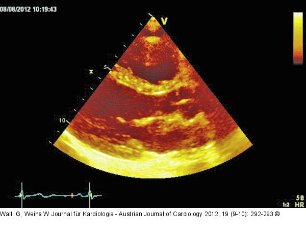 Parasternaler Längsschnitt